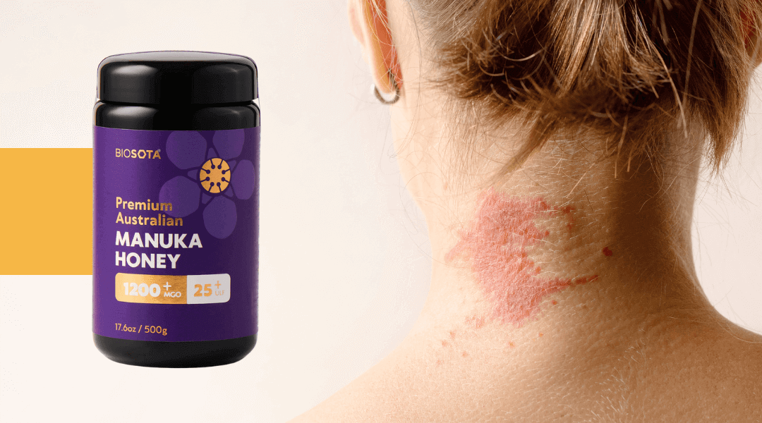 Manuka honey benefits for eczema